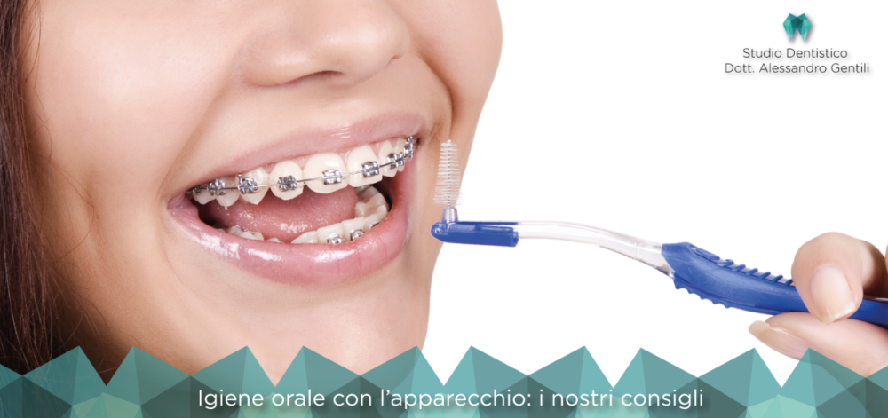 Igiene orale con l’apparecchio