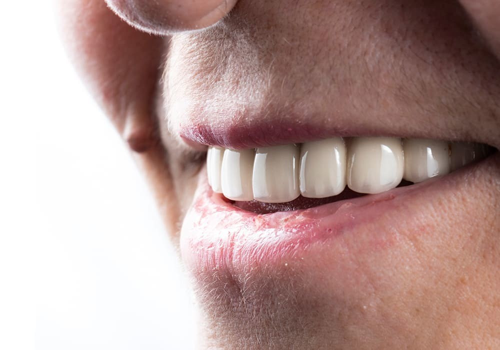 Impianti dentali