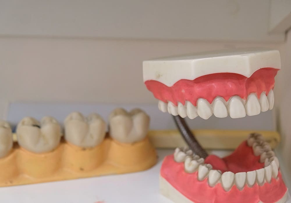 Mini impianti dentali