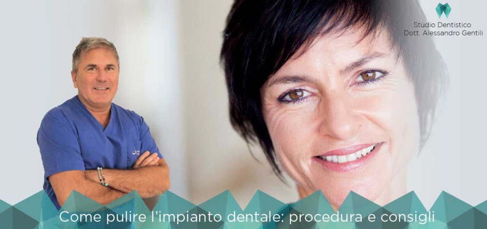 Come pulire l’impianto dentale