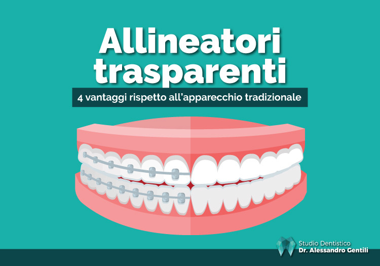 Vantaggi degli allineatori trasparenti: scopri 4 benefici che forse non conoscevi