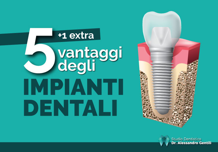 I vantaggi degli impianti dentali: una guida completa