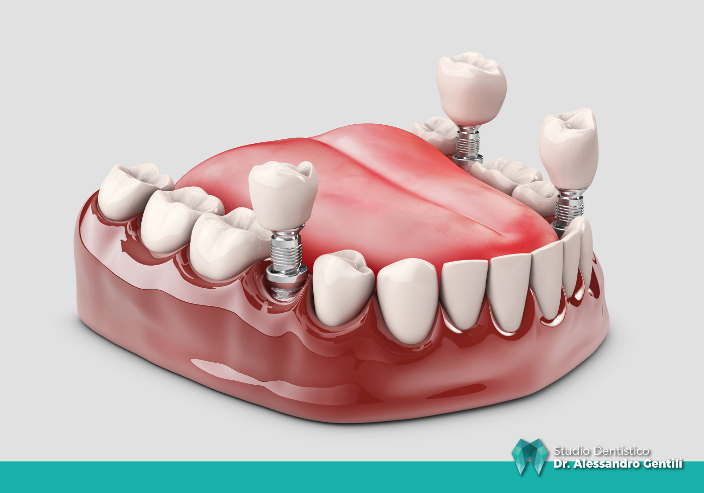 I vantaggi degli impianti dentali: una guida completa